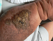 重癥血管瘤病區(qū)