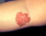 習(xí)慣性流產(chǎn)專區(qū)