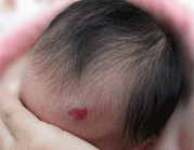 嬰兒血管瘤專區(qū)