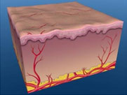 達到血管清除目的