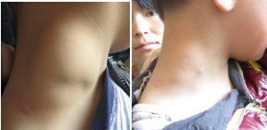 靜脈男科治療前后圖片