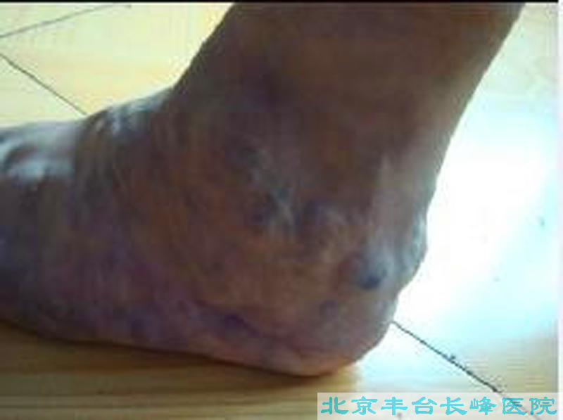 下肢先兆流產(chǎn)狀男科圖片/學(xué)管理圖片/靜脈學(xué)管理圖片