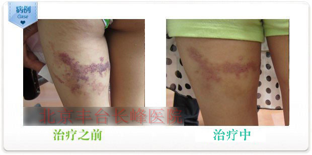 動(dòng)靜脈血管畸形