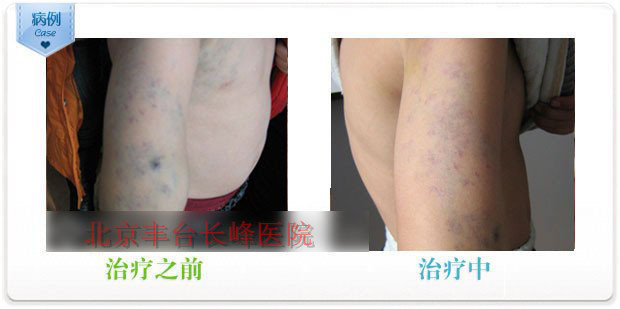 高頻電極術治療