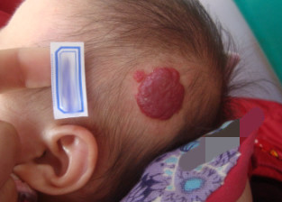 宮頸囊腫的癥狀是什么